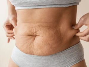 Read more about the article Loose Skin After Weight Loss Women: Causes and How to Tighten It