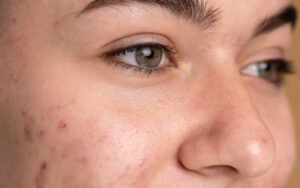 Read more about the article What Are Closed Comedones & How to Treat Them