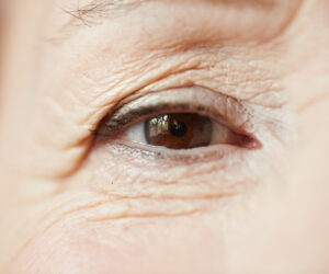 Read more about the article What Causes Wrinkles?