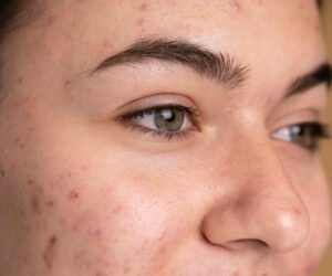 Read more about the article Dark Spots on the Face? Here’s How to Treat Them Safely and Effectively