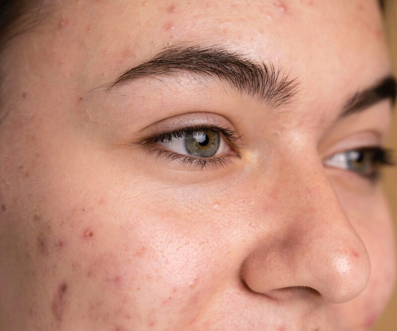 Dark Spots on the Face? Here’s How to Treat Them Safely and Effectively