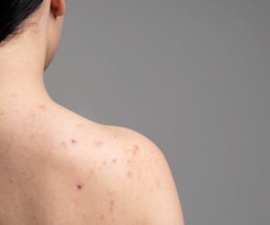 Read more about the article How to Get Rid of Back Acne: 8 Simple Steps to Clear Your Acne