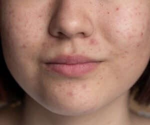 Read more about the article Acne Face Mapping: What Your Breakouts Are Trying to Tell You