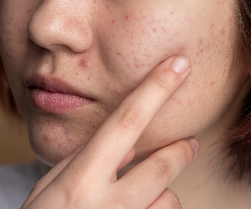 You are currently viewing Fungal Acne Skincare Routine That Works