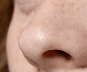 Read more about the article How To Get Rid Of Blackheads Easily