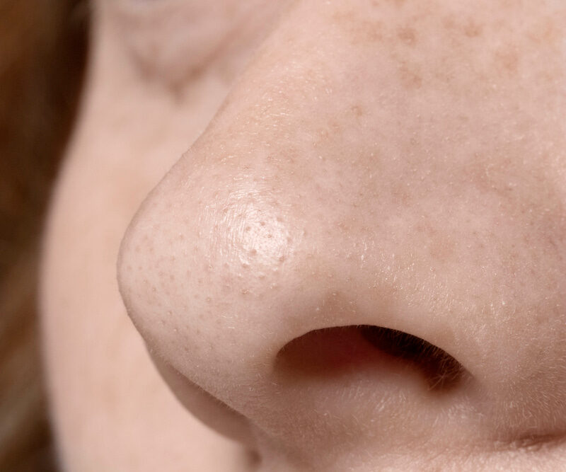You are currently viewing How To Get Rid Of Blackheads Easily