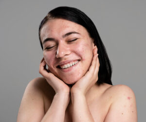 Read more about the article 11 Proven Tips For Fighting Acne