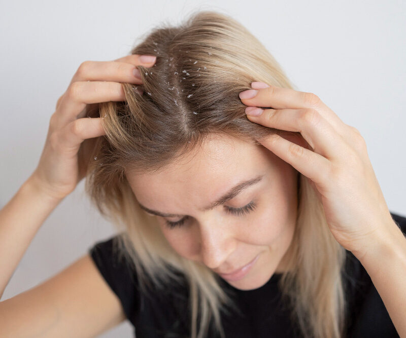 You are currently viewing 11 Home Remedies To Get Rid Of Dry Scalp