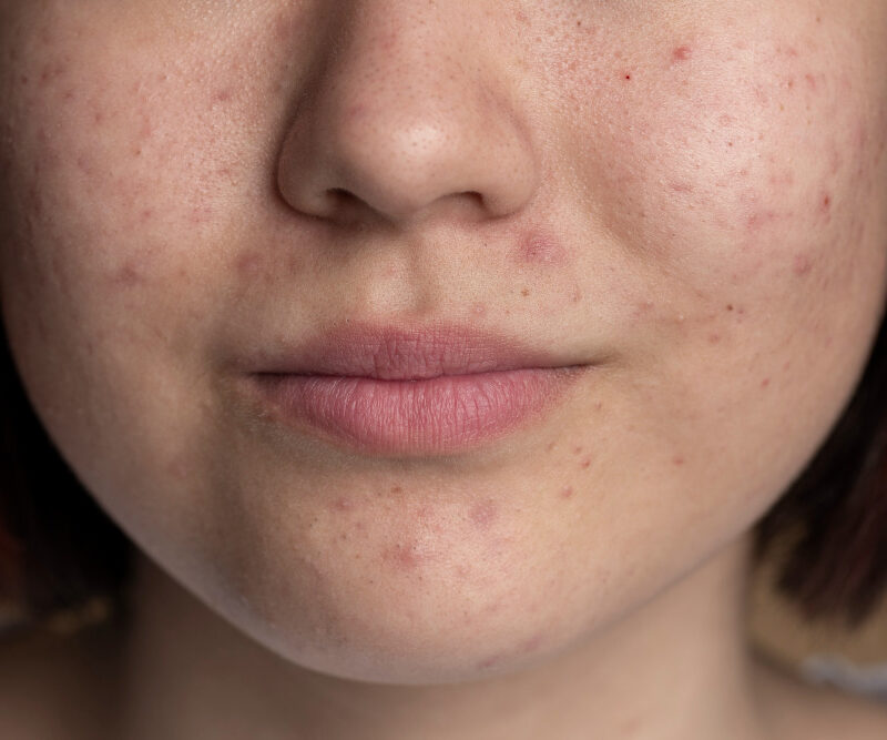 You are currently viewing 5 Natural Products That Actually Work on Acne Scars
