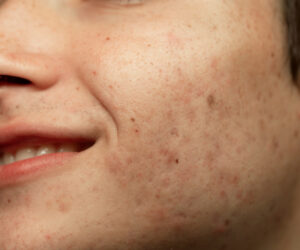 Read more about the article 13 Signs That You Have Hyperpigmentation