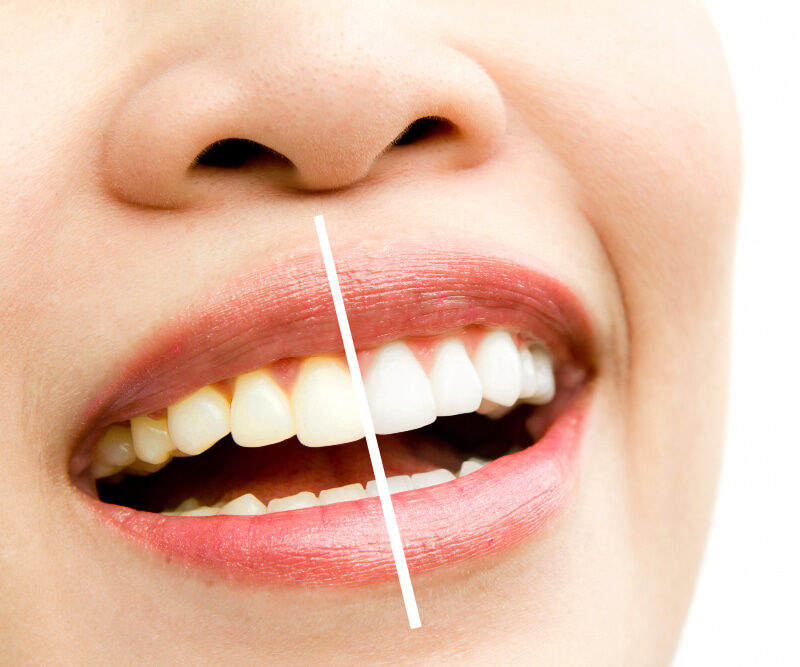 You are currently viewing 9 Tips for Whiter Teeth That Really Work