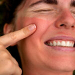 11 Home Remedies for Sunburn- for this Summer