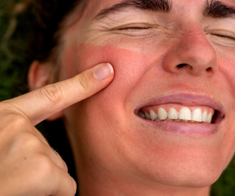 11 Home Remedies for Sunburn- for this Summer