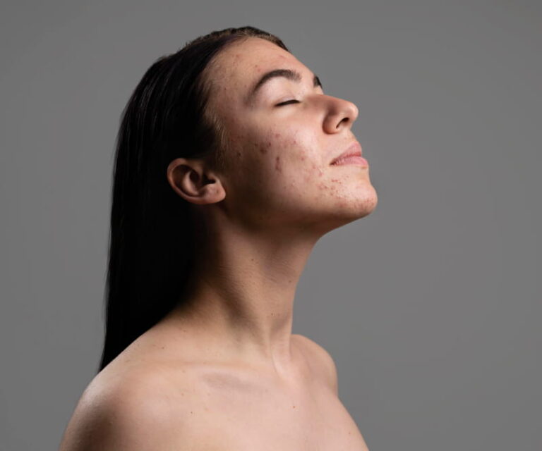 Why Your Jawline Keeps Breaking Out — And It Might Not Be Hormones